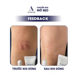 Feedback của khách hàng về viên uống Actiscar