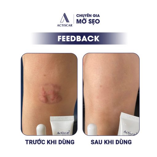 Feedback của khách hàng về viên uống Actiscar