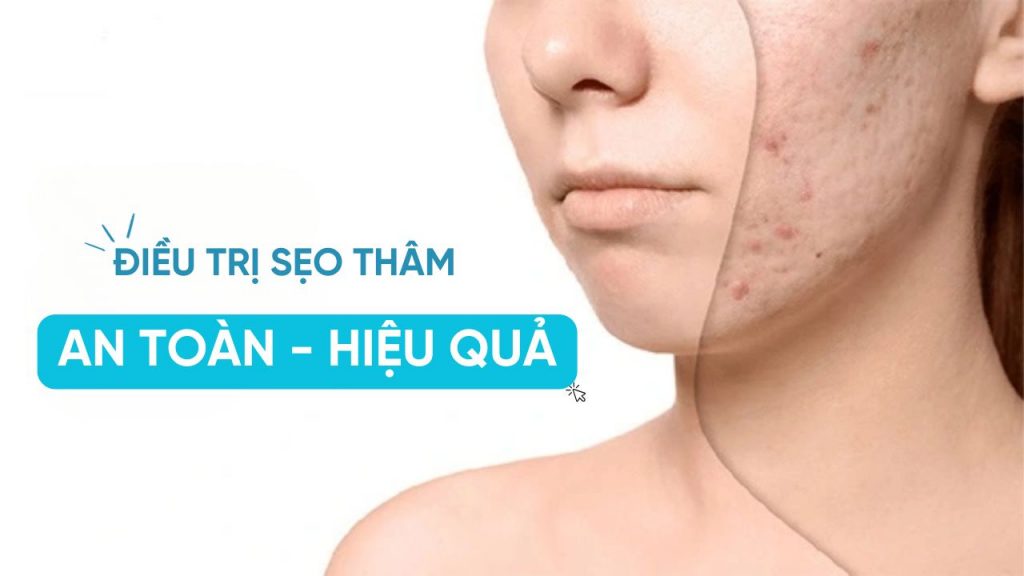 Có nhiều phương pháp điều trị sẹo thâm