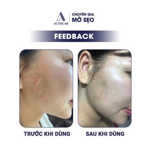 Feedback người dùng về combo trị sẹo lồi Actiscar