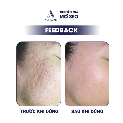 Feedback của khách hàng về kem trị sẹo lõm Actiscar