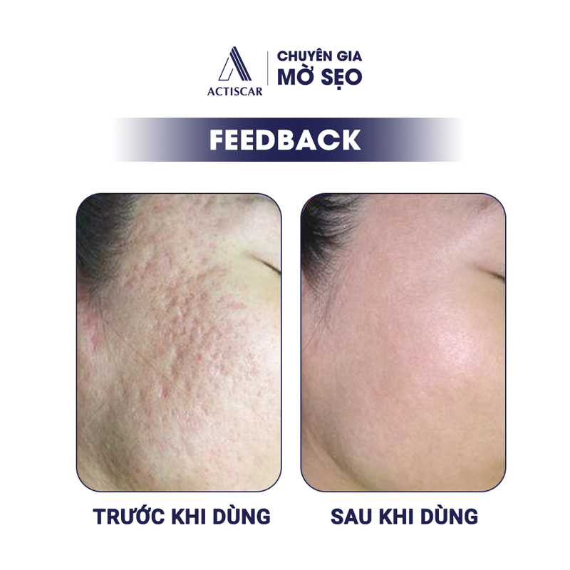 Feedback của khách hàng về kem trị sẹo lõm Actiscar