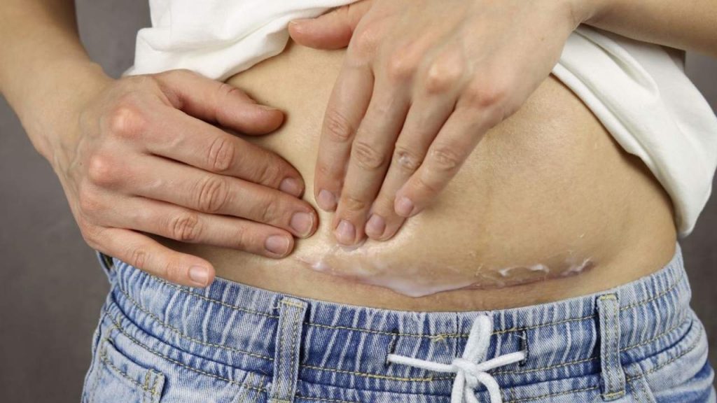 Một số vấn đề cần lưu ý khi sử dụng kem trị sẹo sau phẫu thuật