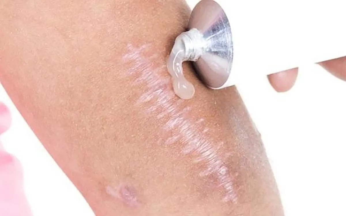 Cùng Actiscar điểm danh những sai lầm nghiêm trọng thường mắc khi xử lý sẹo thâm - Ảnh 2. Cùng Actiscar điểm danh những sai lầm nghiêm trọng thường mắc khi xử lý sẹo thâm - Ảnh 2.