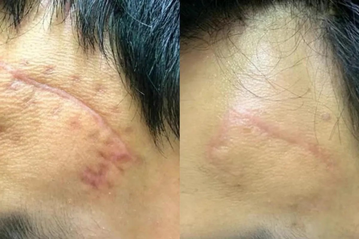 Cùng Actiscar điểm danh những sai lầm nghiêm trọng thường mắc khi xử lý sẹo thâm - Ảnh 5. Cùng Actiscar điểm danh những sai lầm nghiêm trọng thường mắc khi xử lý sẹo thâm - Ảnh 5.