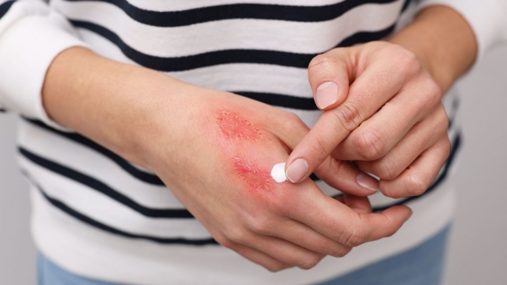 Sẹo bỏng cần được điều trị sớm bằng phương pháp phù hợp