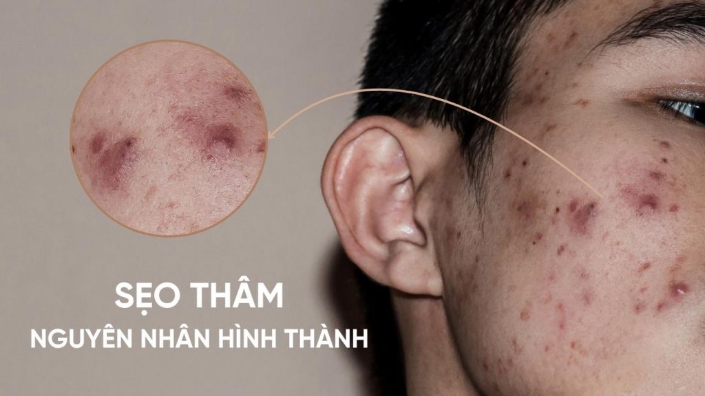 Sẹo thâm khó điều trị gây mất thẩm mỹ
