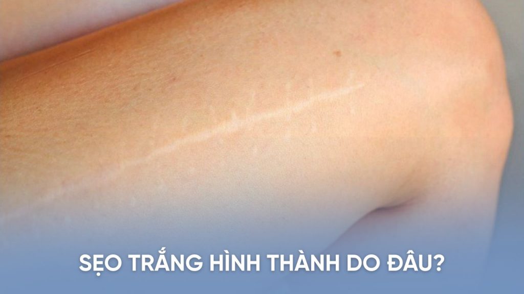 Sẹo trắng: nguyên nhân và thách thức khi điều trị