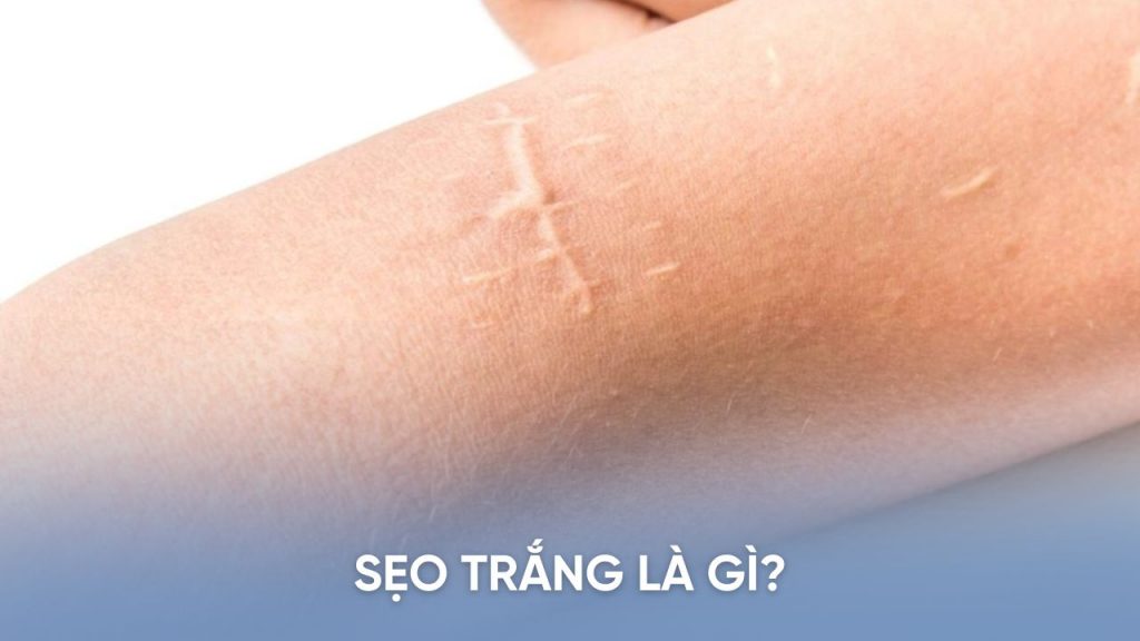 Sẹo trăng và cách nhận biết sẹo trắng