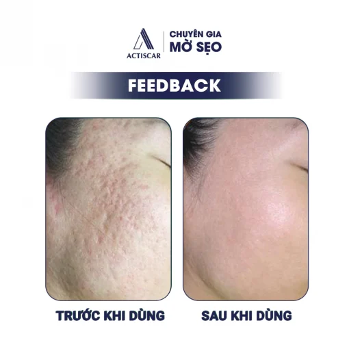 Serum Sẹo Lõm Acticsar 20ml