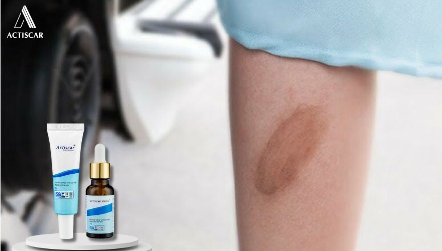 Actiscar - Giải pháp kem trị sẹo bỏng bô an toàn, lành tính