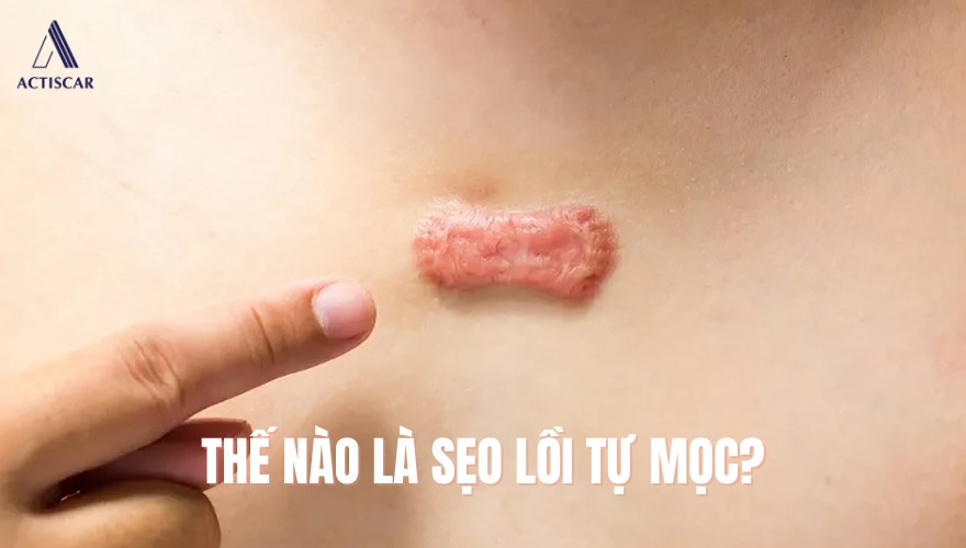 Biểu hiện của sẹo lồi tự mọc