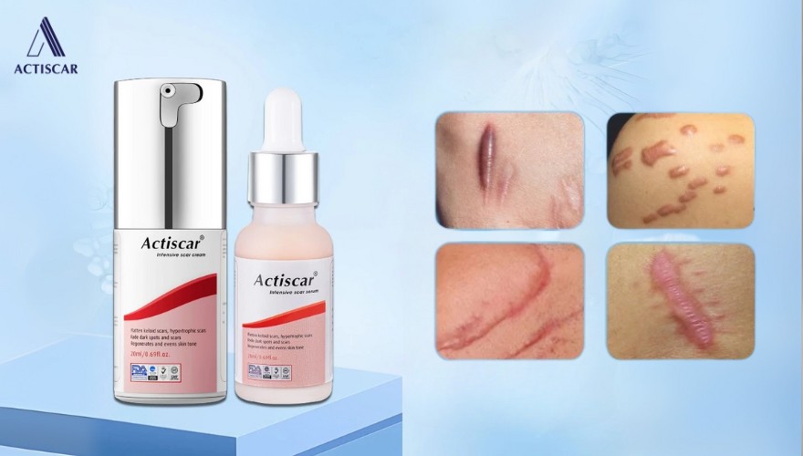Bộ đôi Actiscar: giải pháp xử lý sẹo lồi hiệu quả