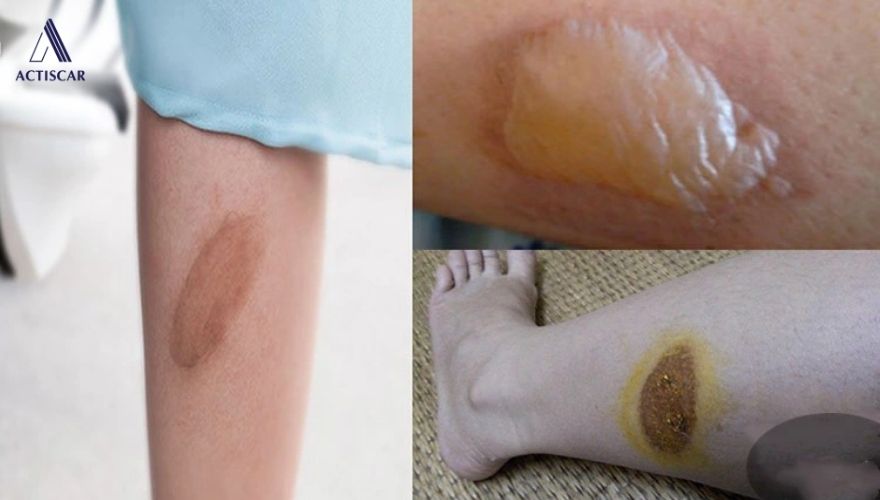 Bỏng bô để lại sẹo xấu trên da sau khi lành