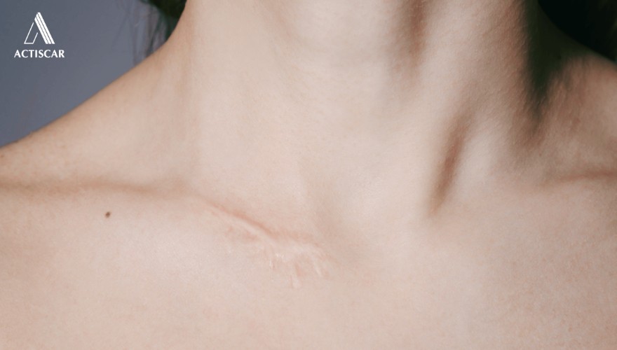 các bước xử lý sẹo lồi co kéo trên cơ thể