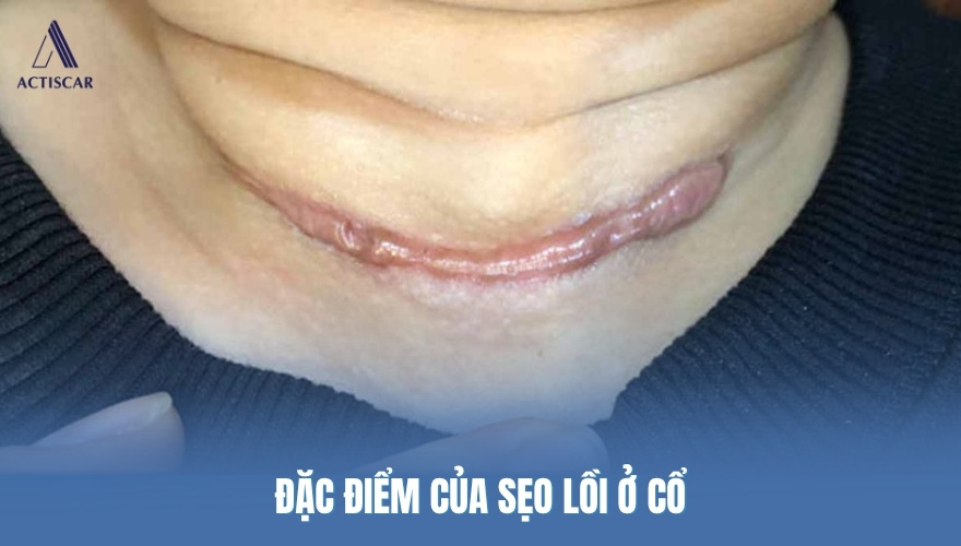 Các đặc điểm nổi bật của loại sẹo lồi ở cổ