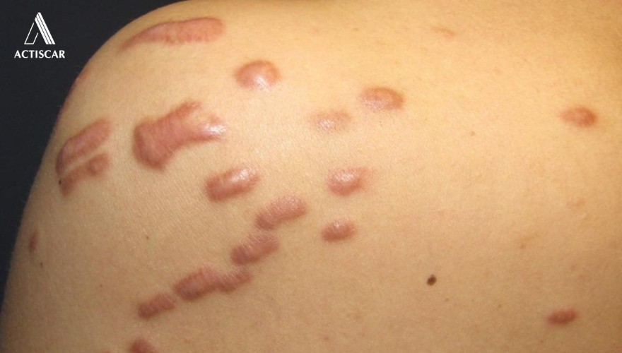 Các đối tượng dễ gặp phải sẹo lồi cơ địa