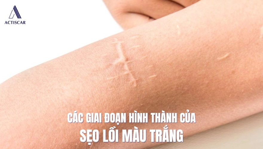 Các giai đoạn của sẹo lồi màu trắng