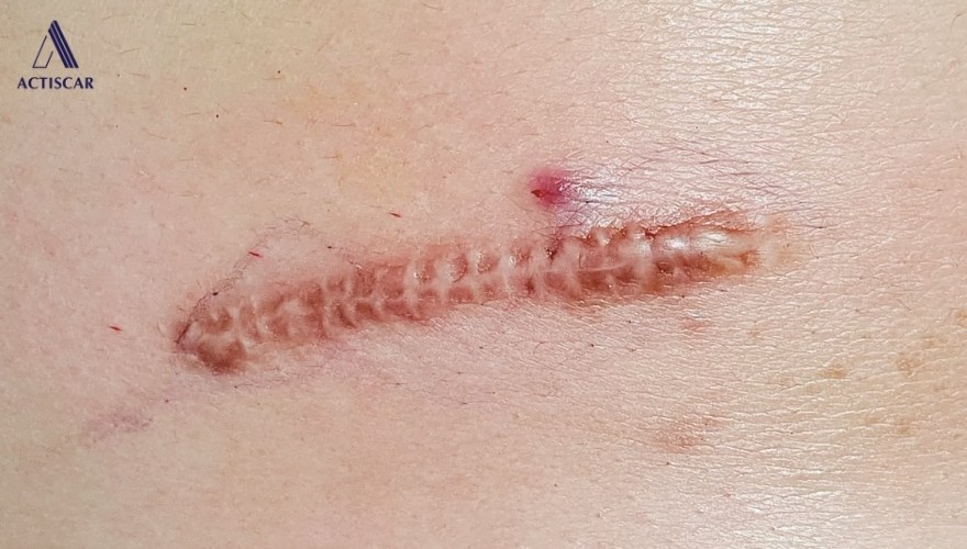 Các yếu tố khiến sẹo lồi có khả năng bị thâm