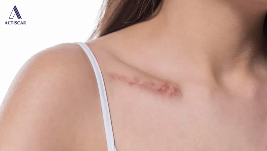 Cách để chăm sóc và ngăn ngừa sẹo lồi tại nhà