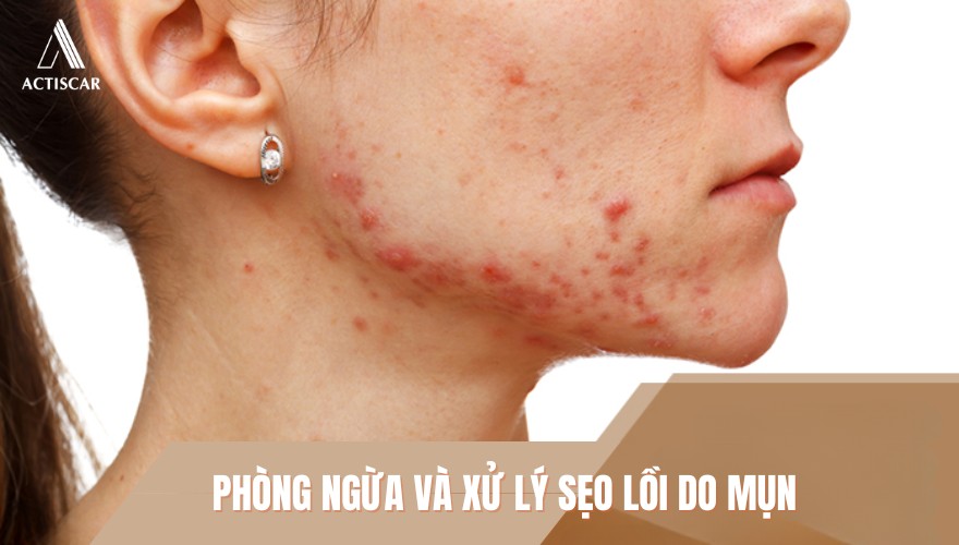 Cách phòng ngừa sẹo lồi do mụn