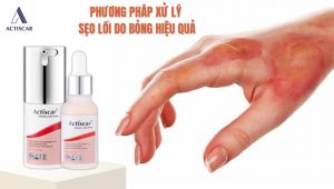 Cách xử lý sẹo lồi do bỏng tại nhà an toàn, hiệu quả