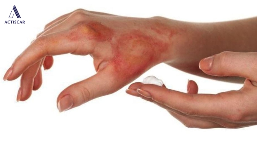Chăm sóc vết thương sau bỏng giúp hạn chế hình thành sẹo