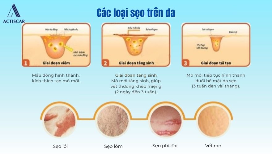 Cơ chế hình thành và các loại sẹo trên da