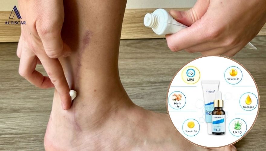 Combo xoá mờ sẹo Actiscar - Giải pháp xử lý sẹo hiệu quả tại nhà