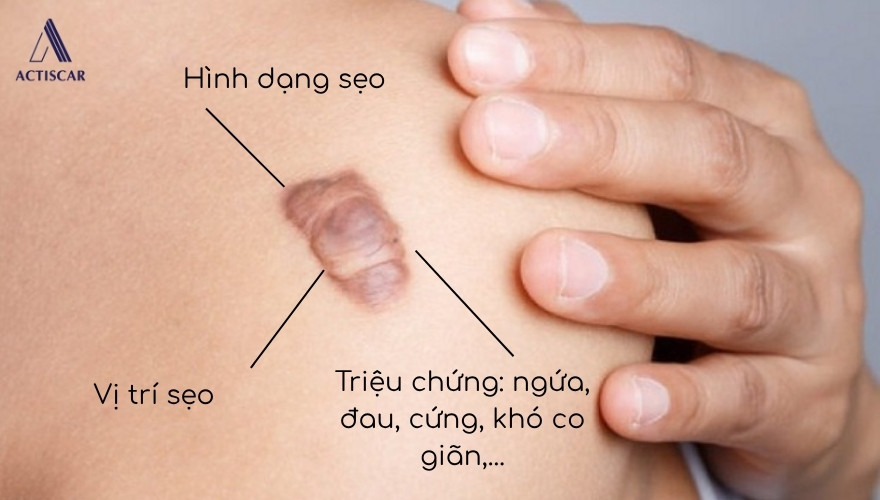 Đặc điểm nhận biết sẹo lồi là gì