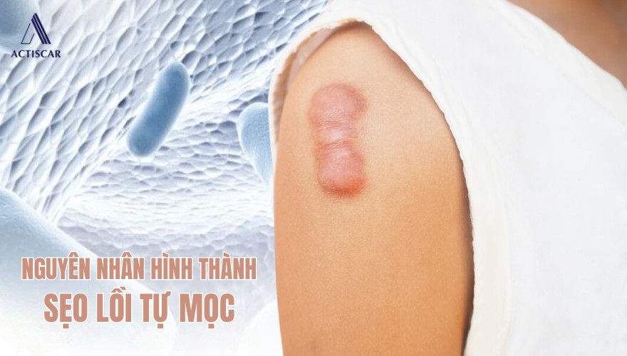 Đâu là nguyên nhân dẫn đến sẹo lồi tự mọc