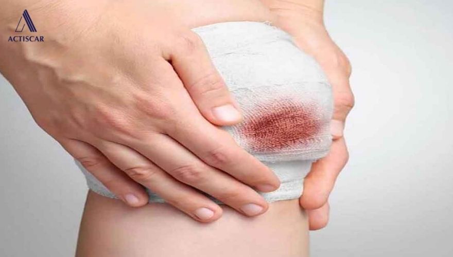 Điều trị sẹo té xe sớm mang lại nhiều lợi ích