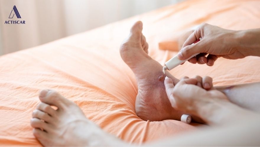 Kem trị sẹo thâm ở chân nhanh nhất, giải pháp an toàn tại nhà