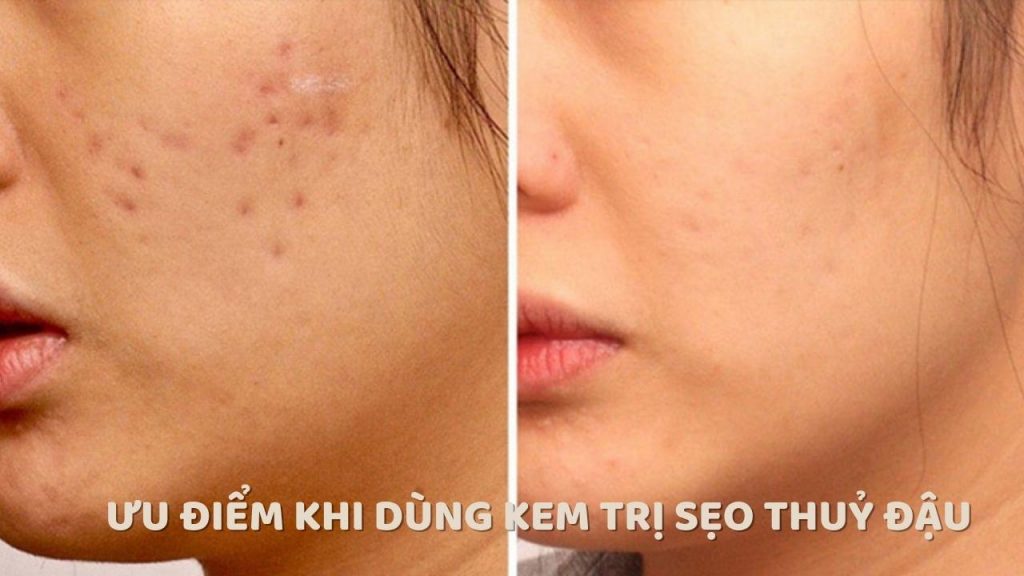 Kem trị sẹo thuỷ đậu mang lại nhiều ưu điểm cho người dùng