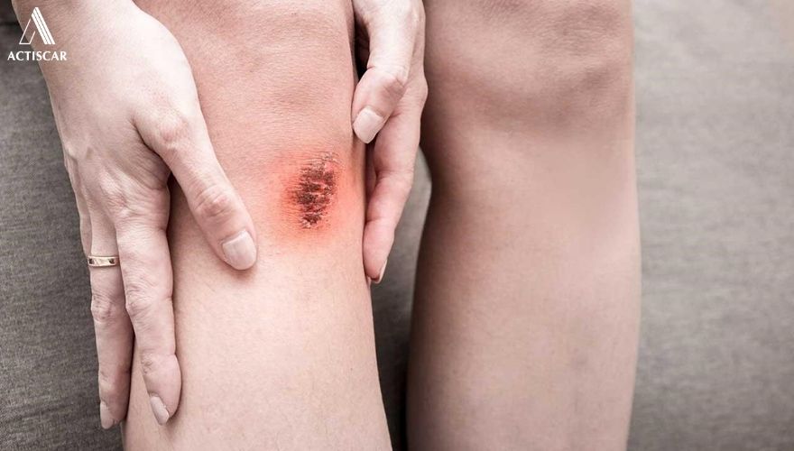 Khi nào nên dùng kem trị sẹo té xe để có hiệu quả tốt nhất