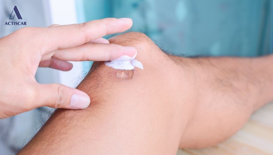 Kinh nghiệm khi trị sẹo ở vùng đầu gối