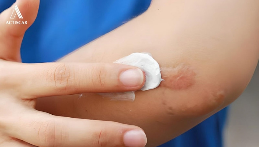 Lựa chọn kem trị sẹo lồi mới hình thành phù hợp mang lại hiệu quả