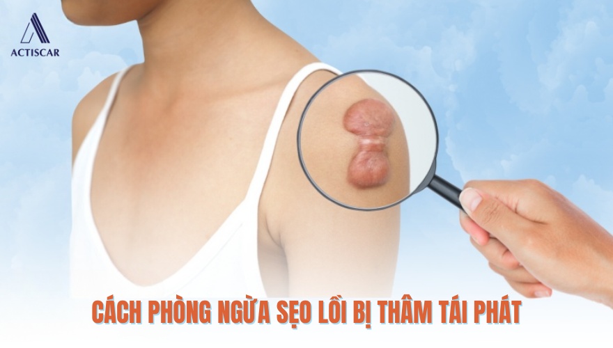 Lưu ý để phòng ngừa sẹo lồi bị thâm tái phát