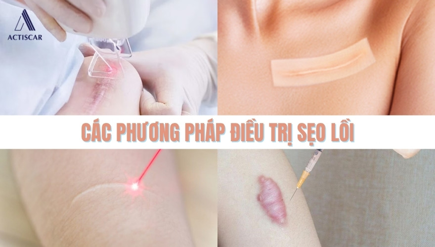 Một số phương pháp điều trị sẹo lồi hiện nay
