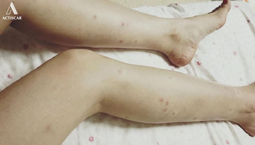 Một số vấn đề được quan tâm về sẹo thâm ở chân
