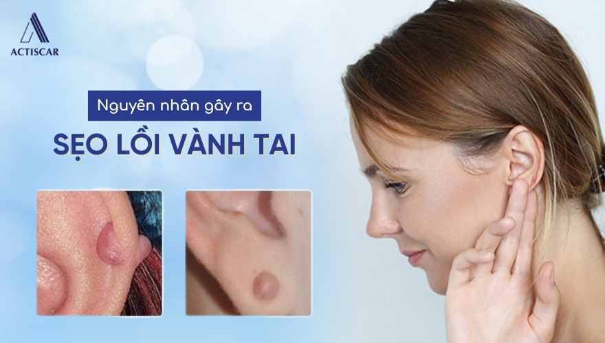Nguyên nhân sẹo lồi vành tai dễ hình thành