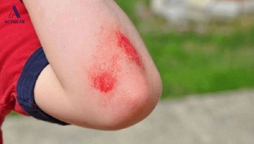 Những điều cần lưu ý khi sử dụng kem trị sẹo té xe