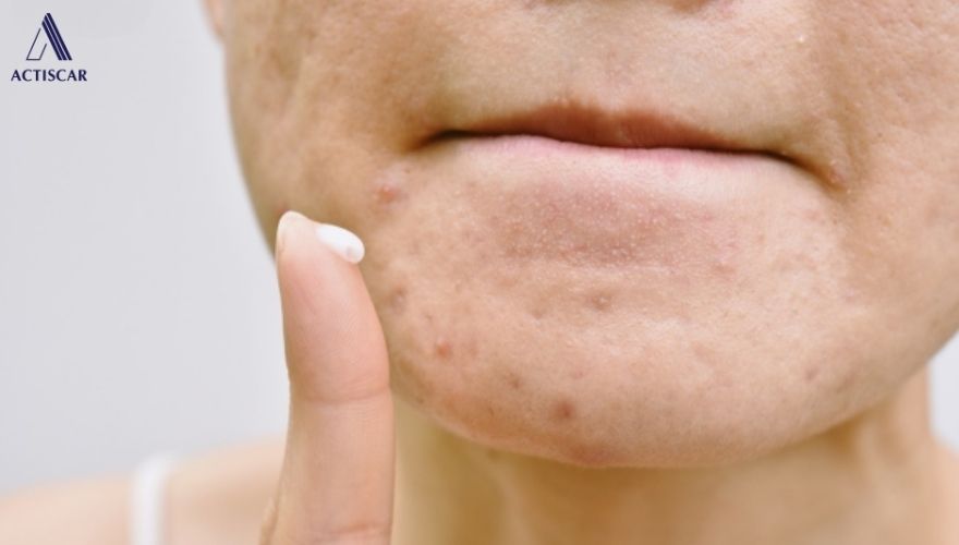 Những điều cần lưu ý trong quá trình sử dụng kem trị sẹo