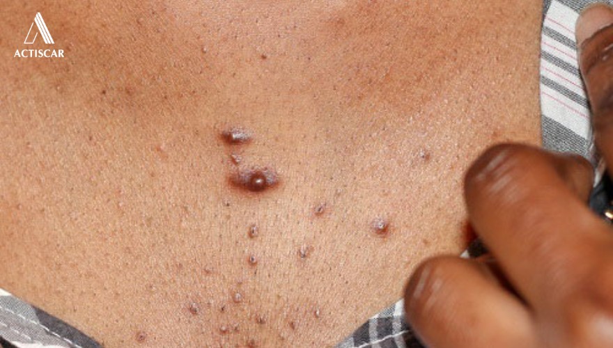 Những nguyên nhân gây ra sẹo lồi do mụn