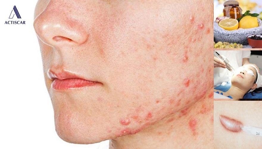 Phương pháp điều trị sẹo lồi trên mặt tại nhà
