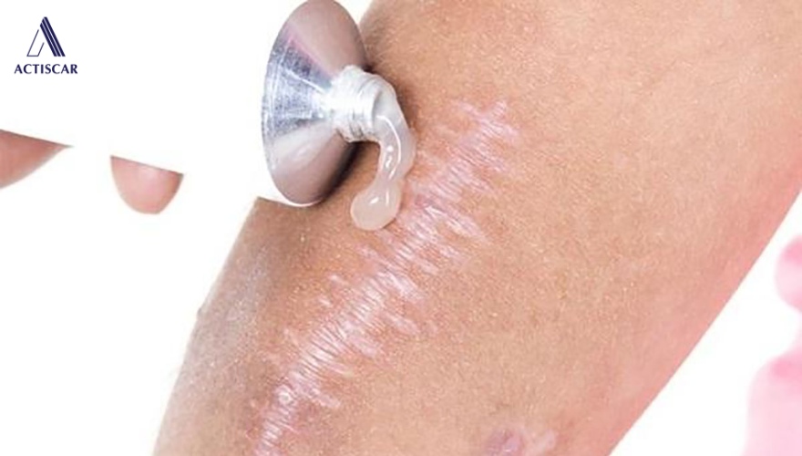 Phương pháp xử lý sẹo lồi an toàn tại nhà
