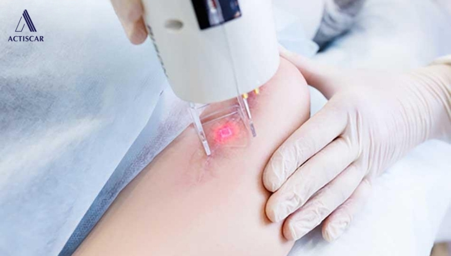 Phương pháp xử lý sẹo lồi bị thâm chuyên sâu