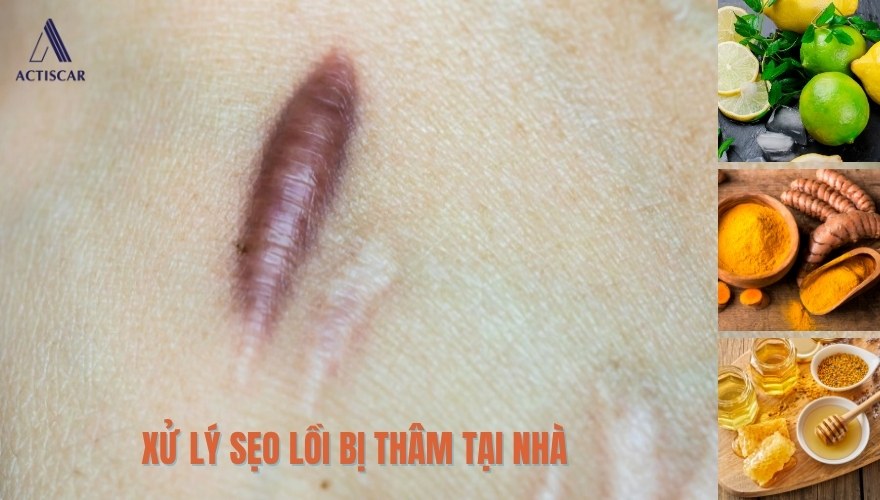 Phương pháp xử lý sẹo lồi bị thâm tại nhà