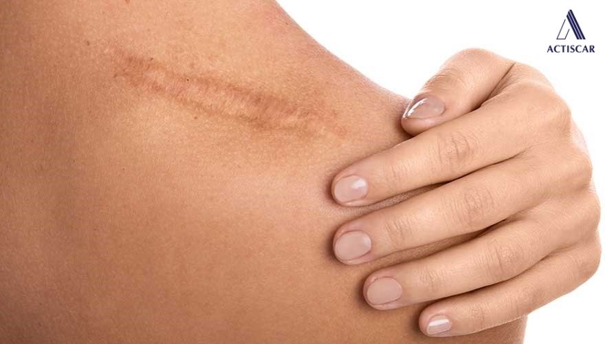 Sẹo lâu năm khó để điều trị hơn so với sẹo mới