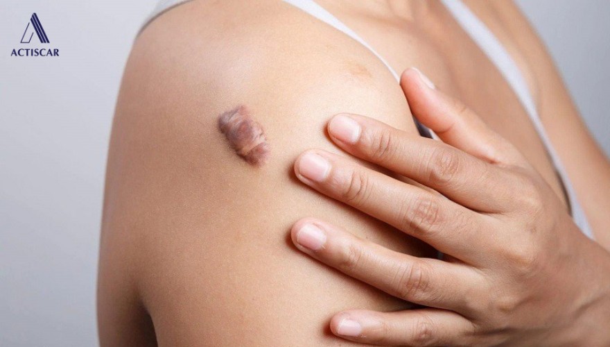 Sẹo lồi cơ địa là gì?